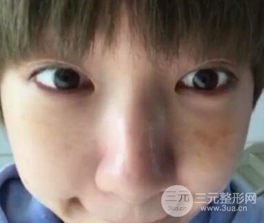 微創(chuàng)內(nèi)切去眼袋手術(shù)價(jià)格和恢復(fù)過(guò)程圖案例