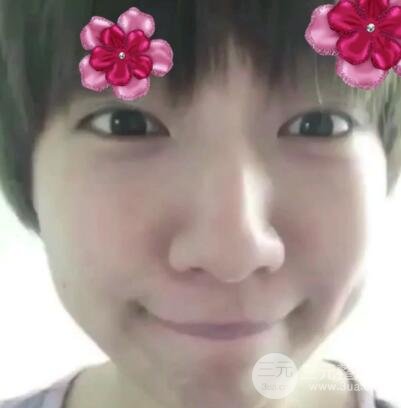 微創(chuàng)內(nèi)切去眼袋手術(shù)價(jià)格和恢復(fù)過(guò)程圖案例