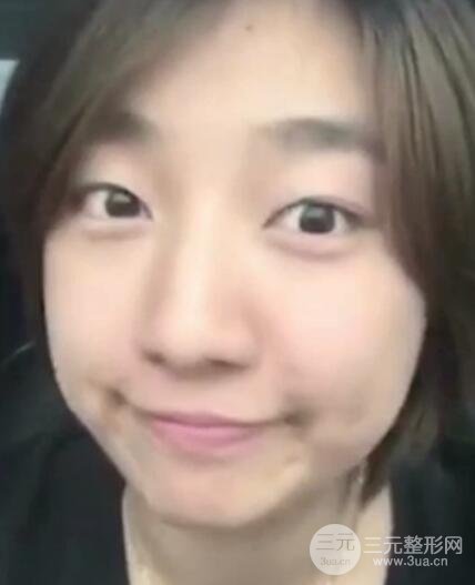 微創(chuàng)內(nèi)切去眼袋手術(shù)價(jià)格和恢復(fù)過(guò)程圖案例