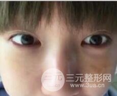 微創(chuàng)內(nèi)切去眼袋手術價格和恢復過程圖案例