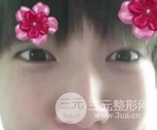 微創(chuàng)內(nèi)切去眼袋手術價格和恢復過程圖案例