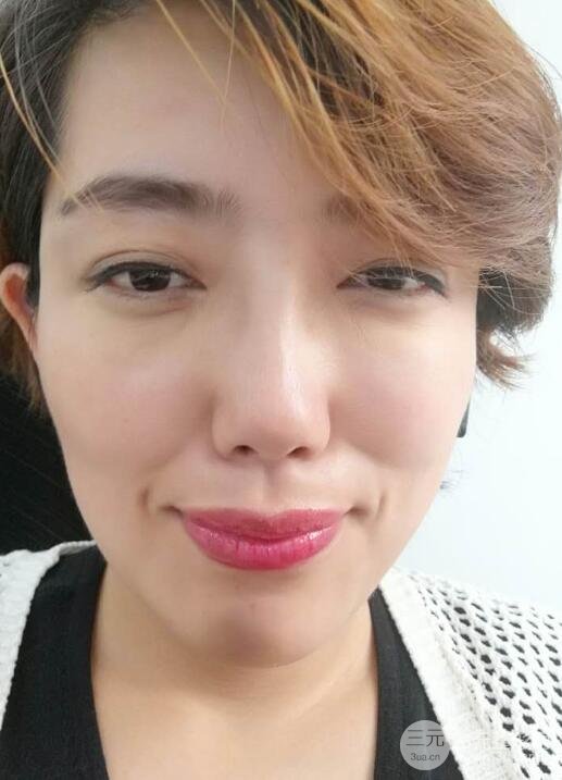 超聲法去眼袋價(jià)格和前后圖片案例