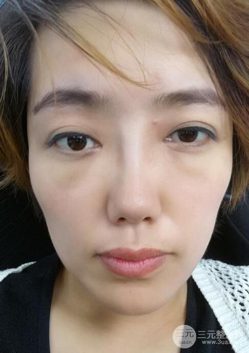 超聲法去眼袋價(jià)格和前后圖片案例