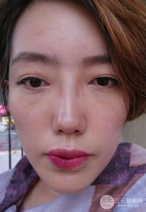 超聲法去眼袋價(jià)格和前后圖片案例