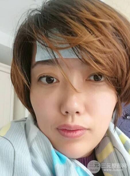 超聲法去眼袋價(jià)格和前后圖片案例