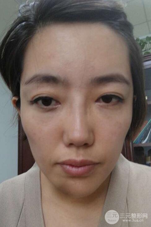 超聲法去眼袋價(jià)格和前后圖片案例