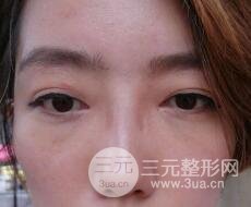 超聲法去眼袋價格和前后圖片案例