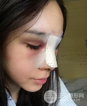 武漢美都張召醫(yī)生給我做的隆鼻整形手術(shù)，給大家分享一下前后照片