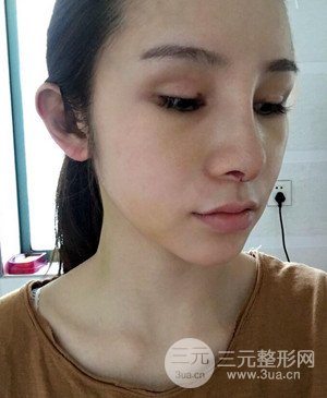 武漢美都張召醫(yī)生給我做的隆鼻整形手術(shù)，給大家分享一下前后照片