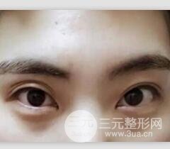 割雙眼皮失敗修復成功價格和案例圖片