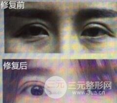 割雙眼皮失敗修復成功價格和案例圖片