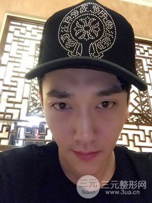 深圳南西子袁新平醫(yī)生給我做的祛眼袋手術(shù)，真實案例以及前后對比照片分享