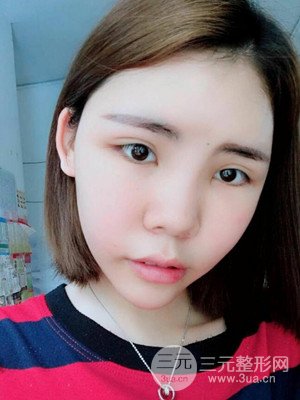 自體脂肪填充全臉真實(shí)案例——濟(jì)南愛(ài)容張慶國(guó)醫(yī)生做的