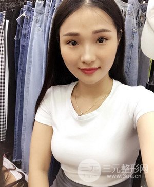 濟(jì)南海峽趙廣生自體脂肪隆胸真實(shí)案例附上前后對比圖