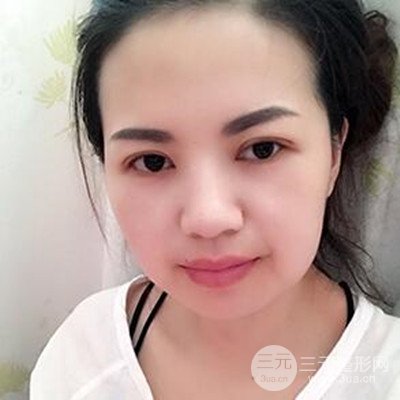 濟(jì)南海峽謝燕燕做的雙眼皮多項(xiàng)整形整形手術(shù)，分享一下前后對(duì)比圖