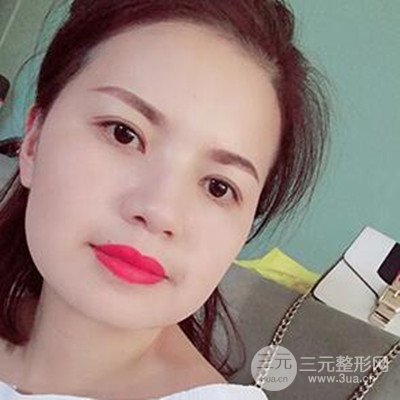 濟(jì)南海峽謝燕燕做的雙眼皮多項(xiàng)整形整形手術(shù)，分享一下前后對(duì)比圖