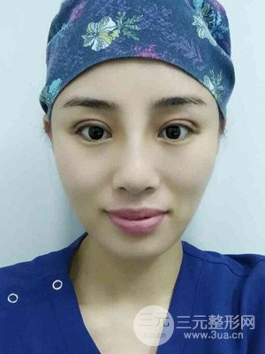 青海康華馬晶醫(yī)生給我做的硅膠假體隆鼻+雙眼皮手術(shù)，分享一下前后對(duì)比圖