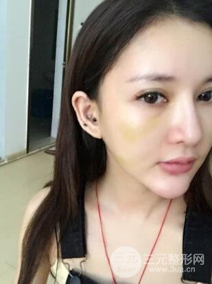 我的埋埋蛋白線.提升日記：真實案例——濰坊華美童艷梅醫(yī)生做的