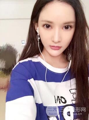 我的埋埋蛋白線.提升日記：真實案例——濰坊華美童艷梅醫(yī)生做的