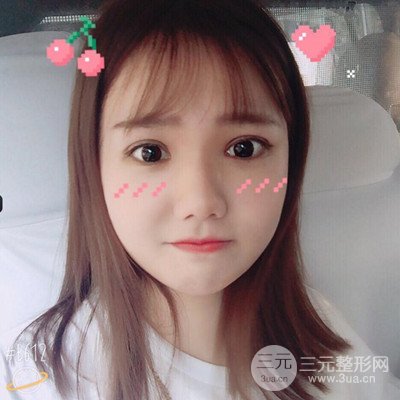 汕頭愛(ài)麗諾蘇國(guó)藝給我做的雙眼皮手術(shù)，把前后的對(duì)比圖片分享給大家