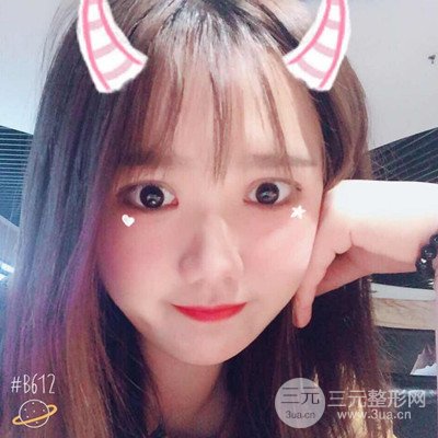 汕頭愛(ài)麗諾蘇國(guó)藝給我做的雙眼皮手術(shù)，把前后的對(duì)比圖片分享給大家
