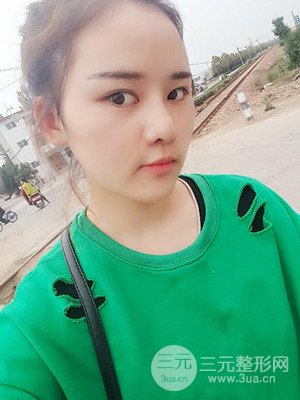 硅膠假體墊下巴真實(shí)案例，汕頭愛(ài)麗諾蘇國(guó)藝做的