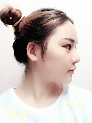 硅膠假體墊下巴真實(shí)案例，汕頭愛(ài)麗諾蘇國(guó)藝做的