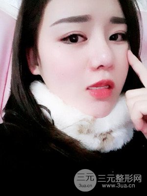 硅膠假體墊下巴真實(shí)案例，汕頭愛(ài)麗諾蘇國(guó)藝做的