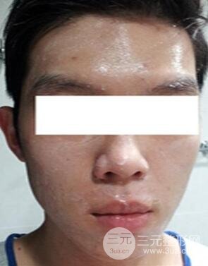 汕頭愛麗諾時(shí)慧醫(yī)生給我做的祛痘，看看前后果如何