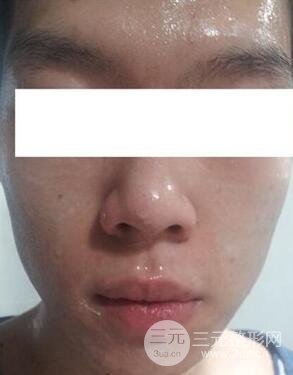 汕頭愛麗諾時(shí)慧醫(yī)生給我做的祛痘，看看前后果如何
