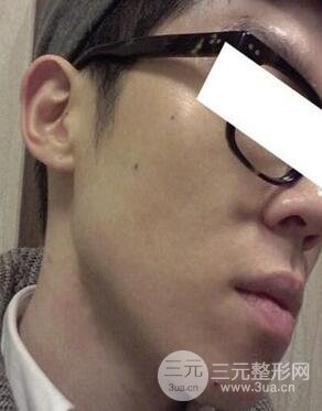 汕頭愛麗諾時(shí)慧醫(yī)生給我做的祛痘，看看前后果如何