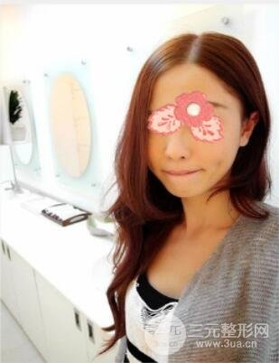 埋埋蛋白線.提升真實(shí)案例分享：汕頭愛麗諾時(shí)慧醫(yī)生做的