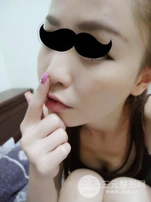 埋埋蛋白線.提升真實(shí)案例分享：汕頭愛麗諾時(shí)慧醫(yī)生做的