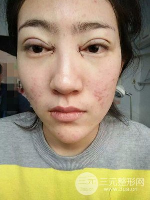 雙眼皮修復(fù)+開內(nèi)眼角真實案例附上前后對比圖片——汕頭伊麗莎白張紅軍做的