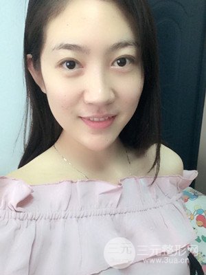 雙眼皮修復(fù)+開內(nèi)眼角真實案例附上前后對比圖片——汕頭伊麗莎白張紅軍做的