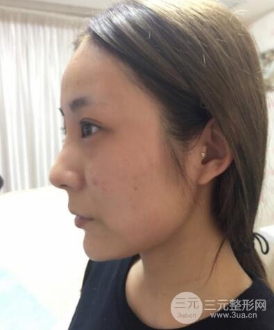 注射玻尿酸注射除皺緊致肌膚前后對(duì)比圖案例