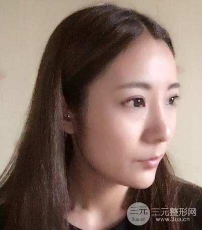 注射玻尿酸注射除皺緊致肌膚前后對(duì)比圖案例