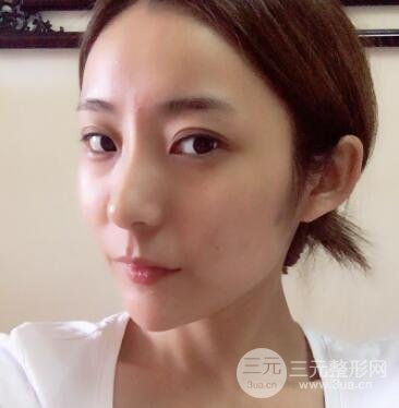 注射玻尿酸注射除皺緊致肌膚前后對(duì)比圖案例