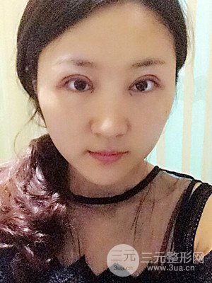 汕頭伊麗莎白孫杰醫(yī)生給我做的切開雙眼皮手術(shù)，分享一下前后對比圖片