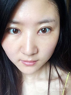 汕頭伊麗莎白孫杰醫(yī)生給我做的切開雙眼皮手術(shù)，分享一下前后對比圖片