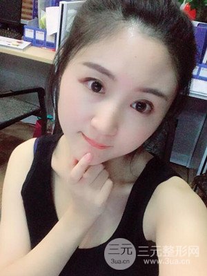 汕頭伊麗莎白孫杰醫(yī)生給我做的切開雙眼皮手術(shù)，分享一下前后對比圖片