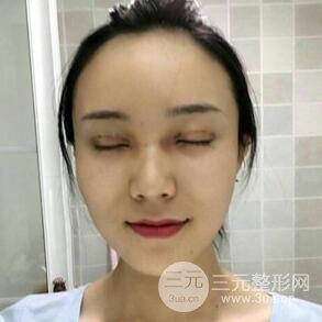 雙眼皮+開內(nèi)眼角手術(shù)前后對比圖片，真實案例