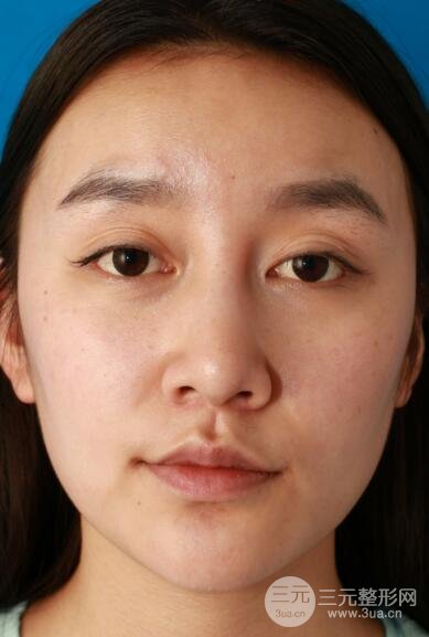 深圳源美做隆鼻失敗修復(fù)價(jià)格案例