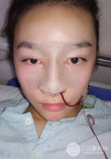 深圳源美做隆鼻失敗修復(fù)價(jià)格案例