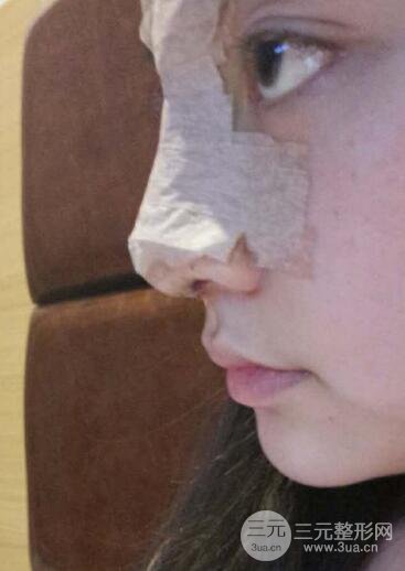 深圳源美做隆鼻失敗修復(fù)價(jià)格案例