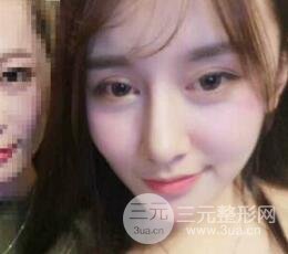 深圳源美做隆鼻失敗修復(fù)價格案例