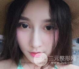 深圳源美做隆鼻失敗修復(fù)價格案例