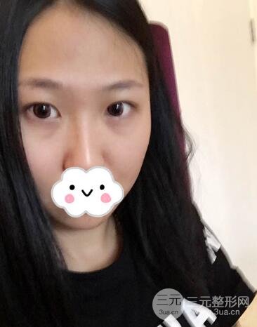 切開雙眼皮無疤痕增生果好圖片案例分享