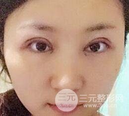 單眼皮割雙眼皮成功案例圖片