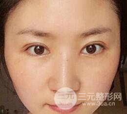 單眼皮割雙眼皮成功案例圖片